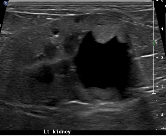 <p>what is going on with this kidney</p>