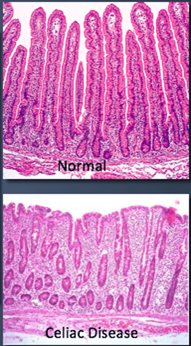 <p>1) Impaired renal function</p><p>2) Autoimmune conditions - Celiac & IBD</p><p>3) Alcoholics</p><p>4) Patients on isoniazid (TB med) or corticosteroids</p>