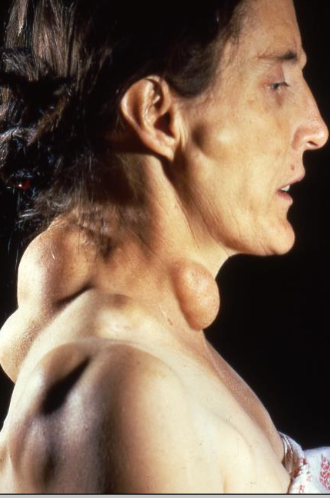 <p>Gardner Syndrome</p>