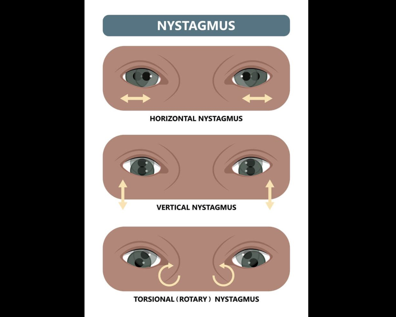 <p>Involuntary rapid eye movements, may indicate vestibular or cerebellar dysfunction. Alcohol can cause this</p>