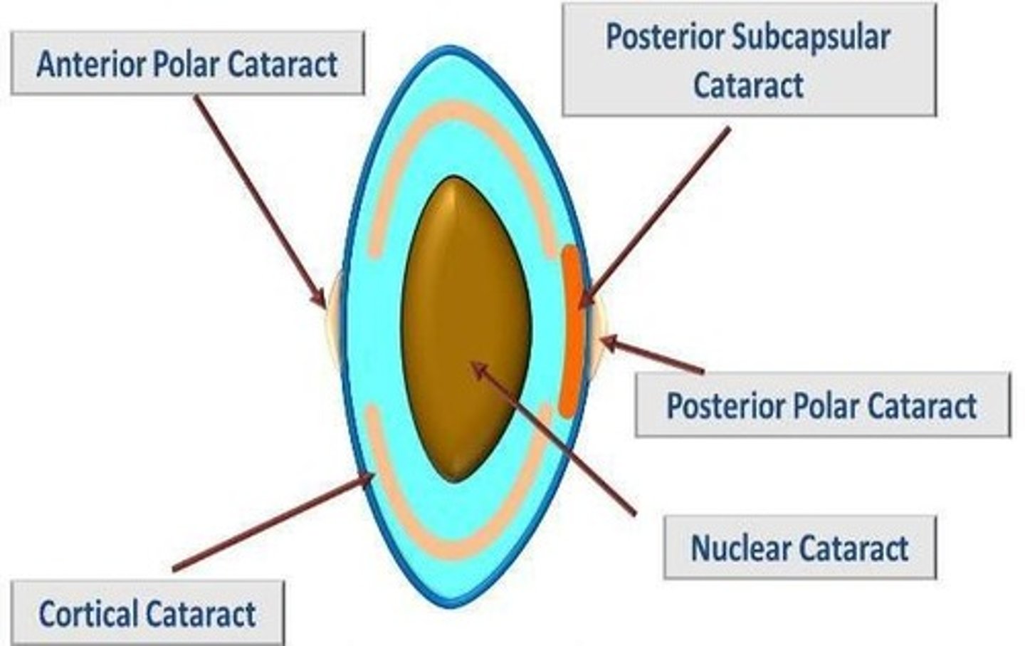 <p>A type of cataract marked by yellowing and hardening of the central lens, often leading to decreased distance vision and temporary improvement in near vision.</p>