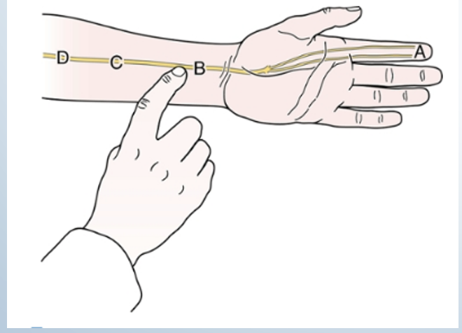 <p><span><strong>•Tests for: </strong>•Carpal tunnel syndrome</span></p><p><span><strong>•Positive sign:</strong></span></p><p><span>•Tingling sensation and paraesthesia into thumb index finger and middle and lateral half of ring finger <strong>(median</strong> nerve distribution)</span></p><p><span>•<strong>Must be felt distal to the tapping</strong></span></p><p><span>•<strong>Indicates rate of regeneration of median nerve</strong></span></p><p><span><strong>•Method: </strong>•Tap the carpal tunnel at the wrist</span></p><p></p>