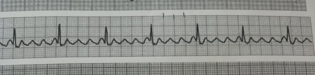 <p>Atrial flutter</p>