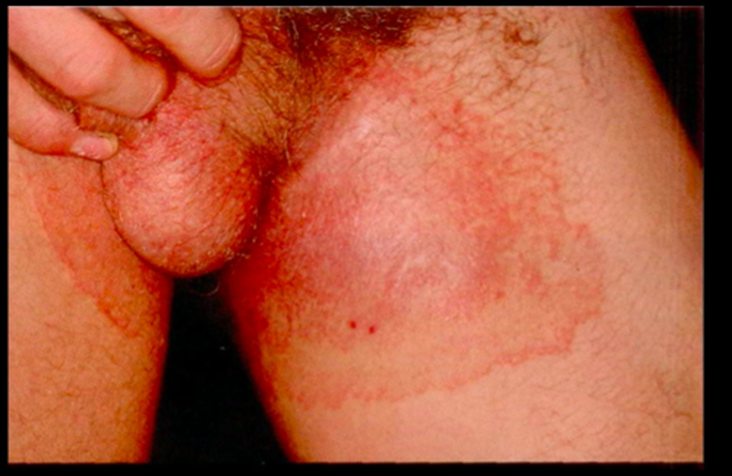 <p>known as Jock itch. it is found in the groin area</p><p>brownish-red lesions in groin area, pruritus, skin excoriation</p>