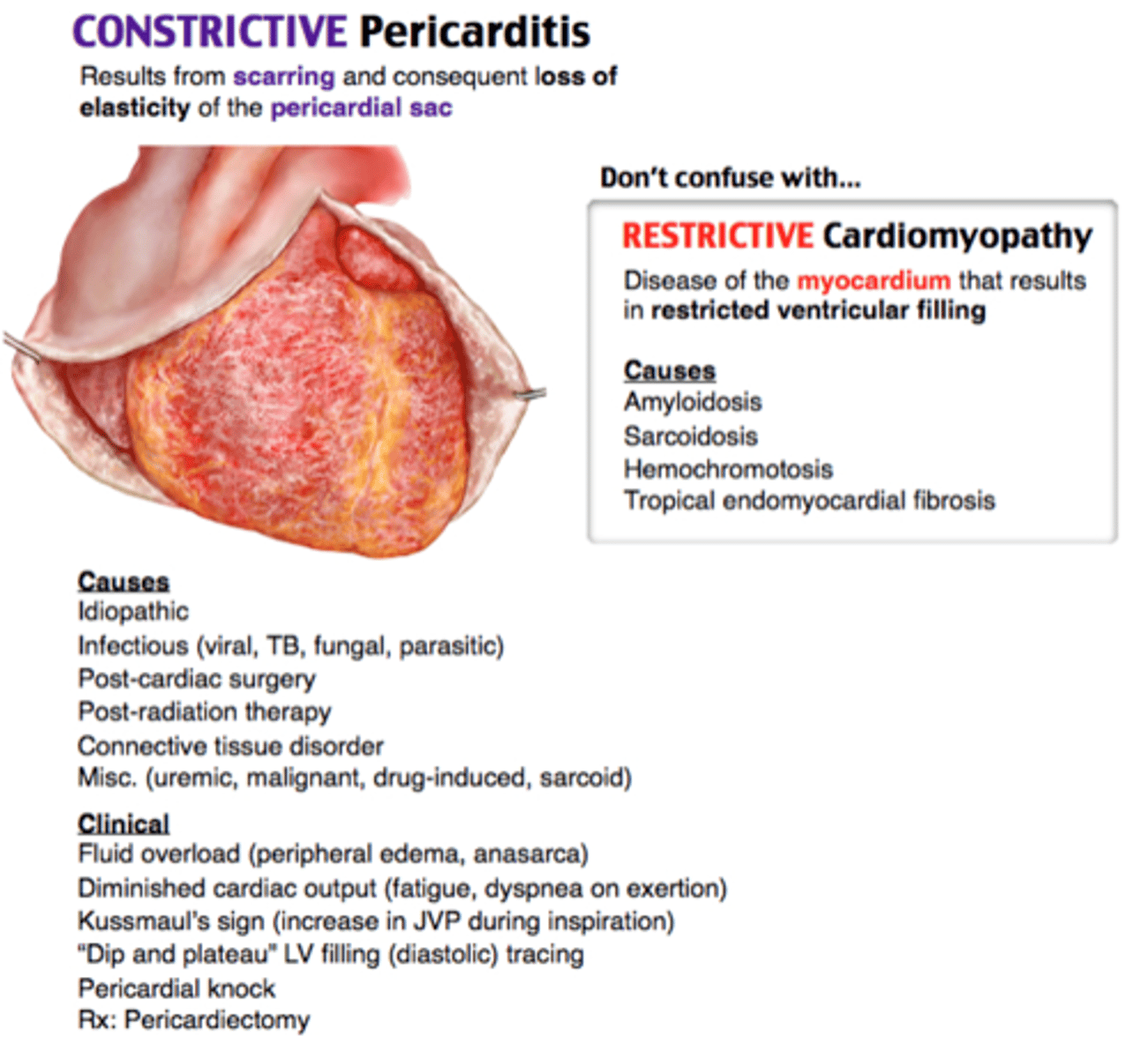 <p>restrictive pericarditis</p>