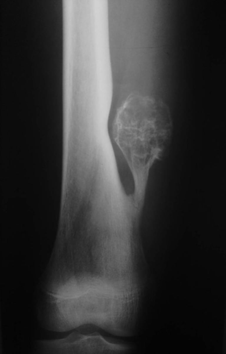 <p>Most likely diagnosis?</p>