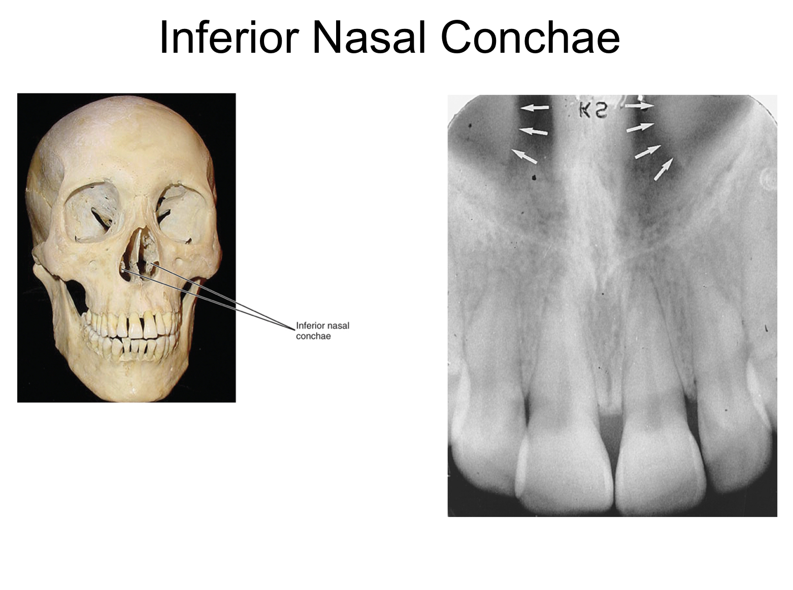 * wafer thin curved plates of bone extend from lateral walls of nasal cavity
* radiopaque