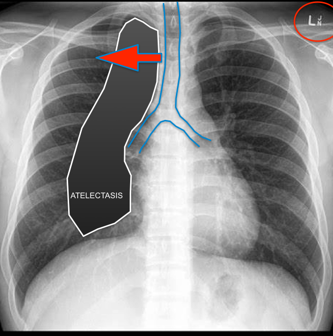 <p>Trachea deviated toward/into the affected lung</p>