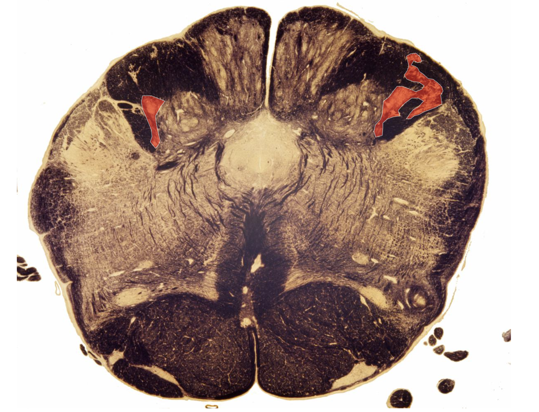 <p><u>Lateral</u> Cuneate Nucleus</p><p>Location of Cell Bodies for the Cuneocerebellar Tract (2nd Order) </p>