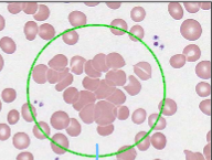 <p>Caused by antigen/antibody interactions between sensitized red blood cells</p>