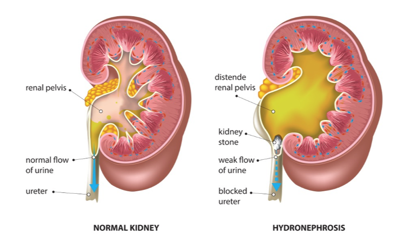 <p>Hydronephrosis</p>