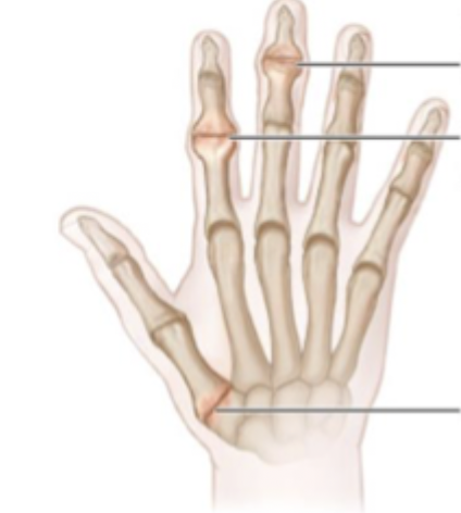 <p>Appear on the DIP joint - may be associated with a digital myxoid pseudocyst</p>