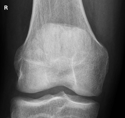 <p>same as AP KNEE, <strong>EXCEPT</strong></p><ul><li><p>BTB is not assessed</p></li><li><p><strong>only</strong>: Alignment, Rotation, IQ</p></li></ul><p></p>