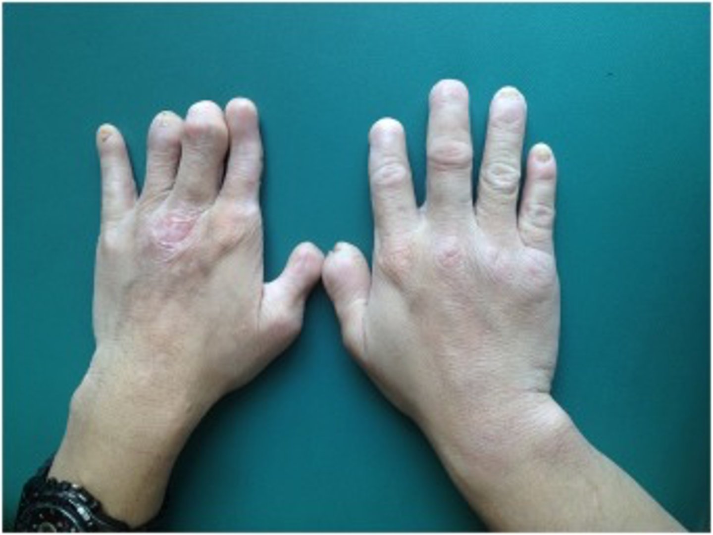 <p>congenital insensitivity to pain; due to INCREASED <b>ENDORPHINS</b> or MUTATED <b>SODIUM CHANNELS</b><br>1. Insensitivity to pain<br>2. Indifference to pain</p>