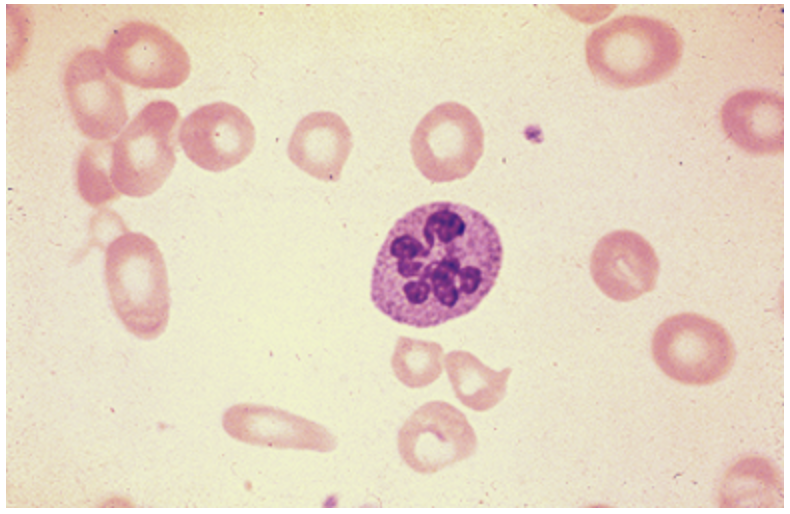 <p>Lab findings in B12 defiencies</p>