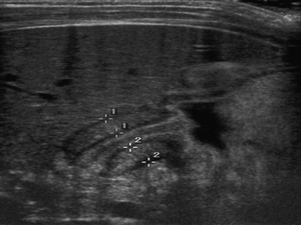 <p>What is the modality of choice for diagnosis of pyloric stenosis?</p>