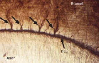 <p><span style="background-color: transparent;"><span>Emaljtufts. Det är små strukturer nära emalj-dentin gränsen orsakade av tidig mineralisering av emaljen (där mineraliseringen av emalj börjar). Under mikroskop ser dessa ut som mörka busk/tofs liknande strukturer.</span></span></p>