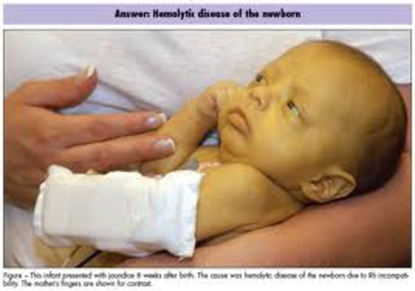 <p>yellow discoloration of skin and sclerae due to excess of blood bilirubin (iron protein breaks down and gives yellow color)</p>