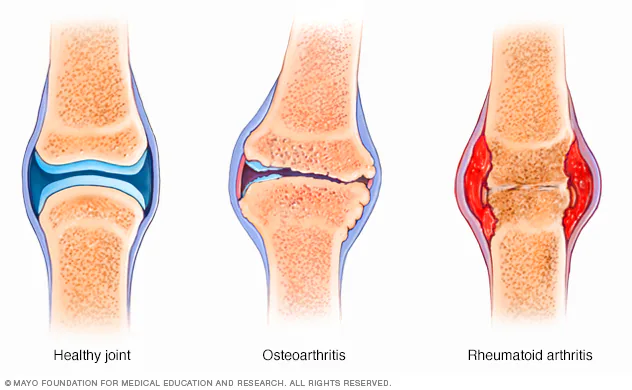 <p>General inflammation or swelling of joints. Symptoms include joint pain, stiffness, lower range of motion, possible discoloration. Treatments include medication and physical therapy. </p>