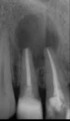 <p><strong>Loss of bone</strong></p>