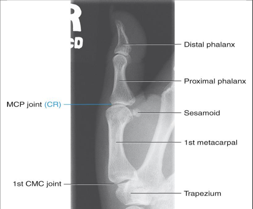 <p><span style="line-height: normal;">• </span>Entire thumb demonstrated including trapezium</p><p class="p1"><span style="line-height: normal;">• </span>Minimal overlap of bases of 1<span style="line-height: normal;">st</span> and 2<span style="line-height: normal;">nd </span>metacarpals</p><p class="p1"><span style="line-height: normal;">• </span>Center of field at first MCP joint</p><p class="p1"><span style="line-height: normal;">• </span>Increased concavity of phalanges on anterior (finger) side</p><p class="p1"><span style="line-height: normal;">• </span>Decreased concavity on posterior side</p>