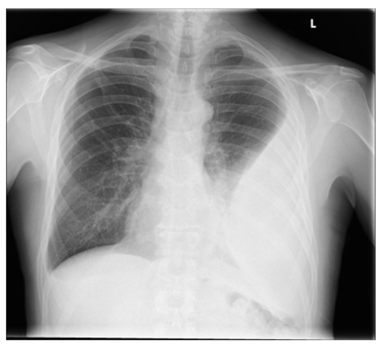 <p>What is the main differentiator between empyema and emphysema on x-ray?</p>