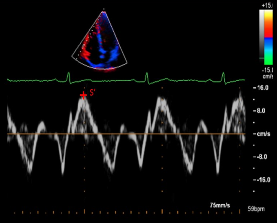 <p>Measurement that determines how fast basal RV free wall moves during systole </p>