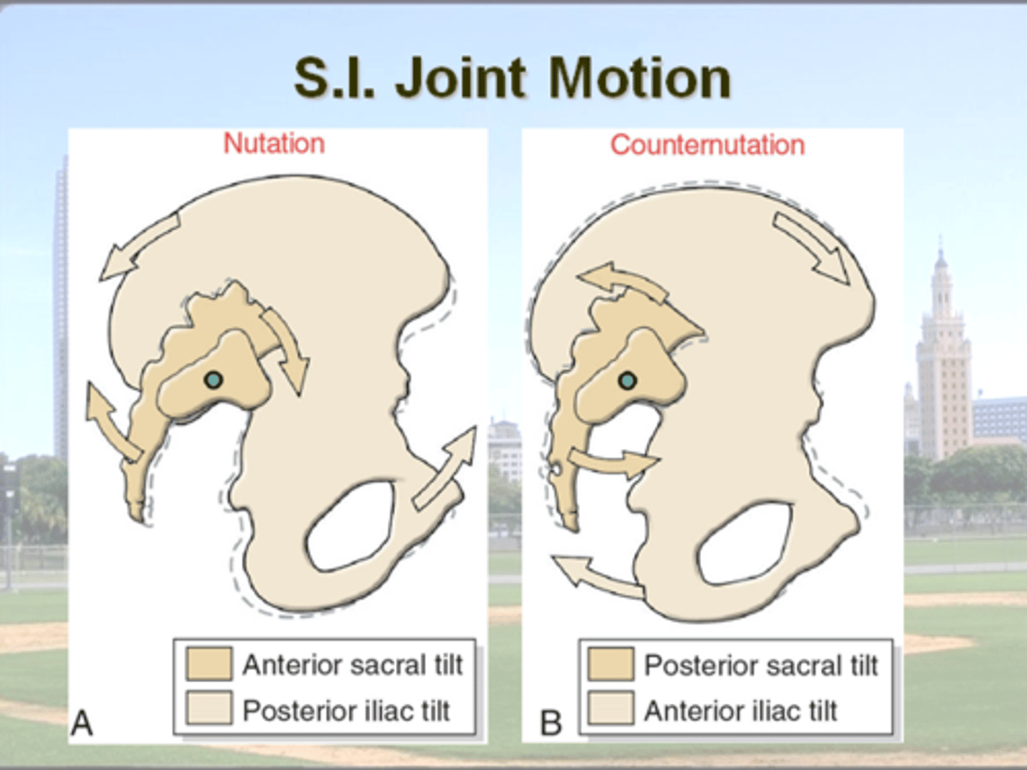 <p>Primary motion of SI</p><p>Flexion (nutation) (nod)</p><p>– anterior tip of sacrum moves anteriorly + inferiorly</p><p>- coccyx moves posteriorly</p><p>vs.</p><p>Extension (counternutation)</p><p>– anterior tip of sacrum moves posteriorly + superiorly</p><p>- coccyx moves anteriorly. </p><p>How do Nutation &amp; Counternutation affect size of the Pelvic Inlet &amp; Pelvic Outlet ??</p><p>pregnancy </p><p>- softening of ligaments</p><p>= increased joint mobility + decreased stability of SI joints </p><p>= likelihood of joint dysfunction and pain.</p>