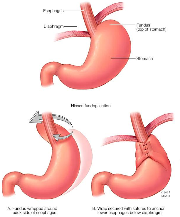 <p>Nissen fundoplication </p><p></p><p>which wraps the stomach around the esophagus but this can loosen over time and limits ability to vomit SO is not commonly used </p>