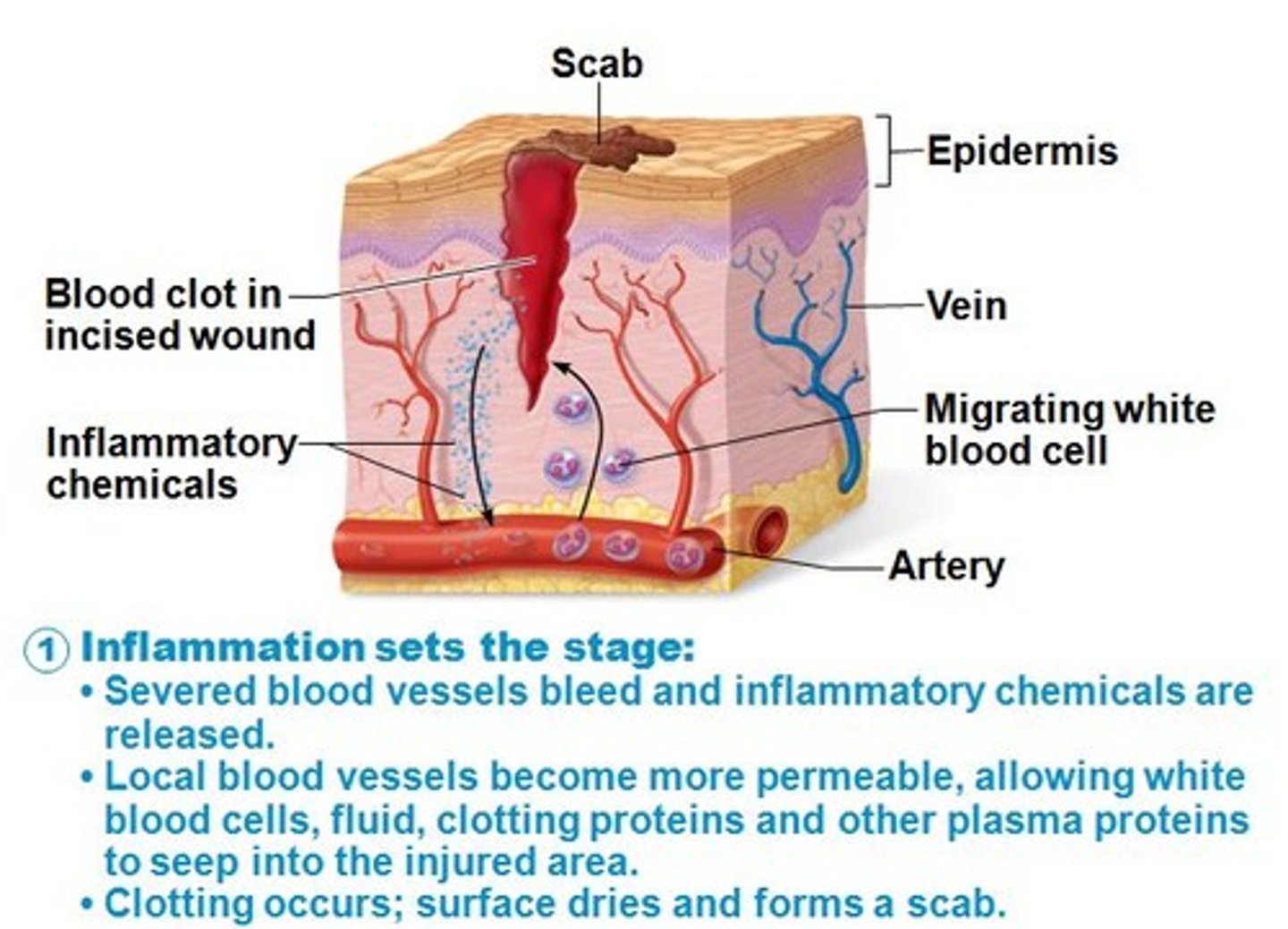 <p>the resulting redness, swelling, heat, and pain in an area of defense by innate immunity</p>