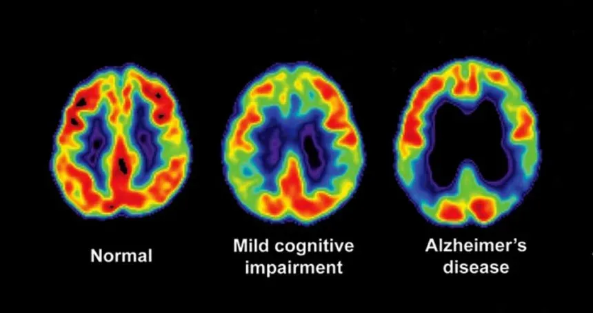 <p>Dementia development</p>