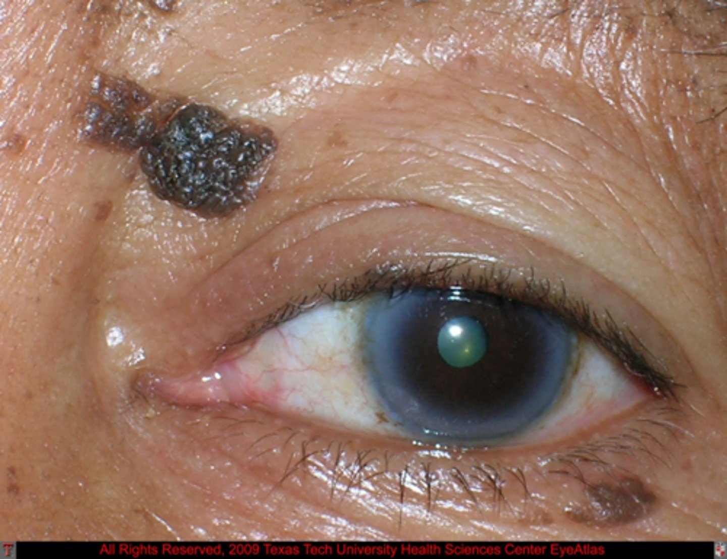 <p>seborrheic keratosis</p>