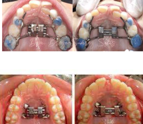 <p>Hyrax disjunctor</p><p>Miniscrews disjunctor</p>