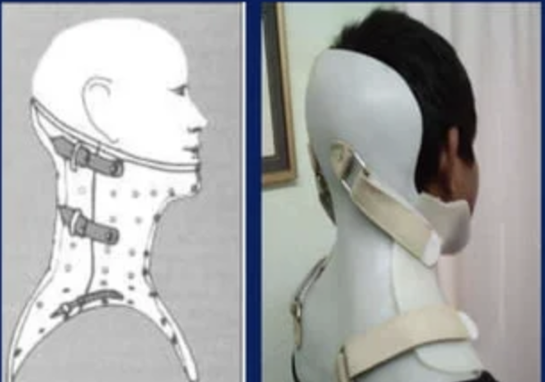 <p>- extend superiorly over the chin, mandible and occiput</p>
<p>- inferiorly may extend up to 1 inc above IAS or further downward towards the inferior coastal margin</p>