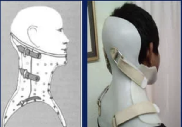 <p>- extend superiorly over the chin, mandible and occiput</p><p>- inferiorly may extend up to 1 inc above IAS or further downward towards the inferior coastal margin</p>