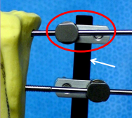 <p><span style="background-color: transparent;"><strong>External Skeletal Fixation</strong></span></p>