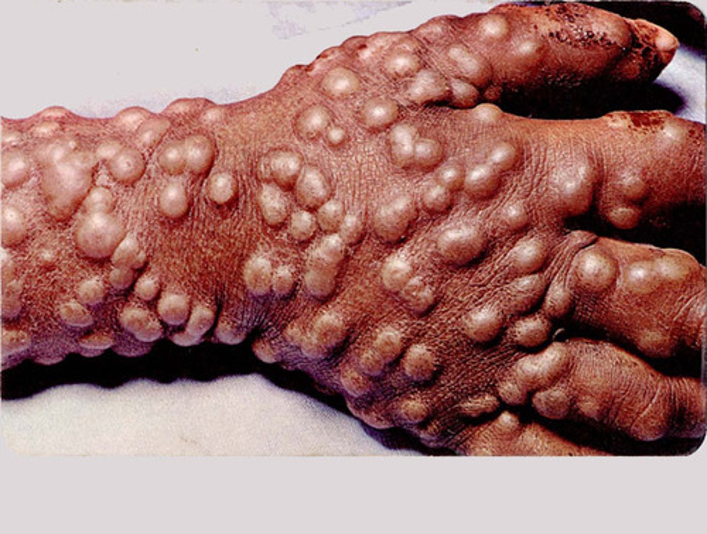 <p>highly infectious and deadly viral disease. it was the first virus immunized against and the first viral disease eradicated.</p>