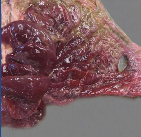 <p>What type of ulcer is this?</p>