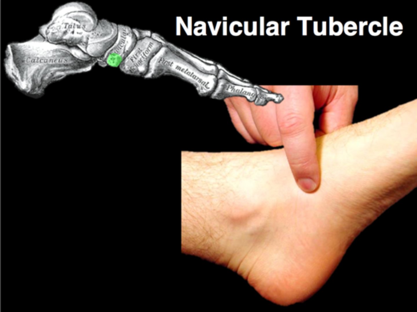 <p>Medial aspect of foot above arch.</p><p>A tarsal bone. Boat shaped.</p><p>tibialis posterior attaches to it.</p>