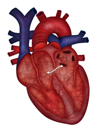 An opening between the right and left atrium present in fetal circulation  