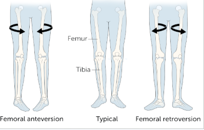 <p>femoral anteversion and retroversion</p>