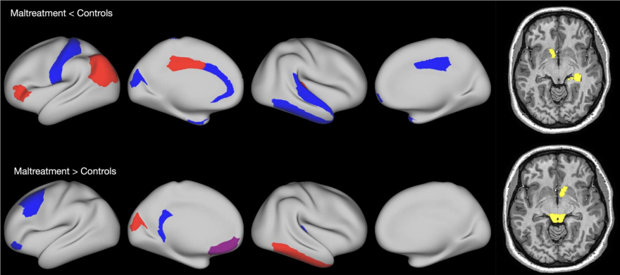 <ul><li><p><strong>Example: </strong>Physical and sexual abuse and neglect</p><ul><li><p>Higher risk of post-traumatic stress disorder and major depressive disorder</p></li></ul></li><li><p><strong>Brain changes:</strong></p></li><li><p><u>Decreased:</u></p><ul><li><p>Surface areas and cortical thickness in frontotemporal regions.</p></li></ul></li><li><p><u>Increased:</u></p><ul><li><p>Cortical thickness in occipital regions and surface areas in frontal regions</p></li></ul></li></ul><p></p>