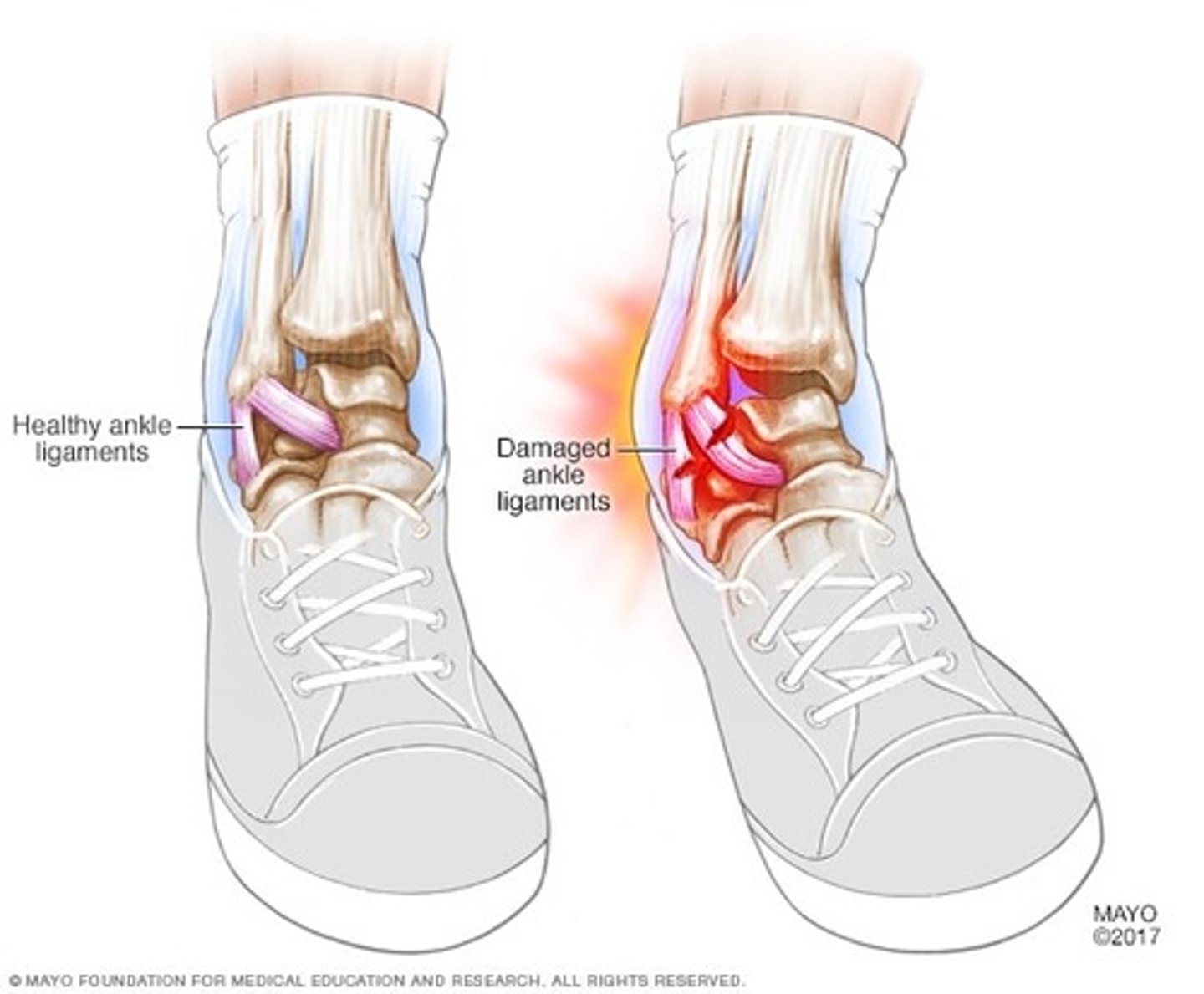 <p>- mechanical overload of a joint</p><p>=> ligament injury = stretch, tear (complete or incomplete), assess for associated bone injury</p><p>- common sprains: ankle (inversion); knee (ACL &amp; MCL); elbow; wrist or ligament tear (eg. ACL tear - more dysfunctional)</p>