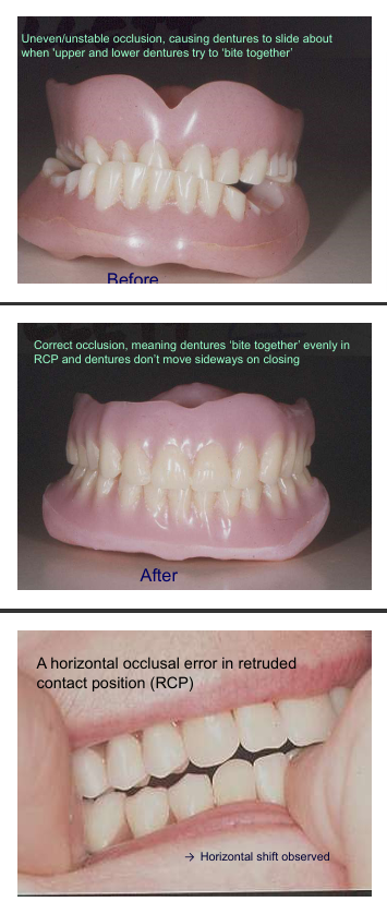 <p>These teeth cannot go together/bite</p><p>teeth don’t meet together causing them slide when teeth meet evenly </p><p>Stops dentures moving about sideways</p><p>if occlusal error horizontal shift may still occur , when pt closes together the denture teeth must close in a denture ICP so ICP=RCP</p>