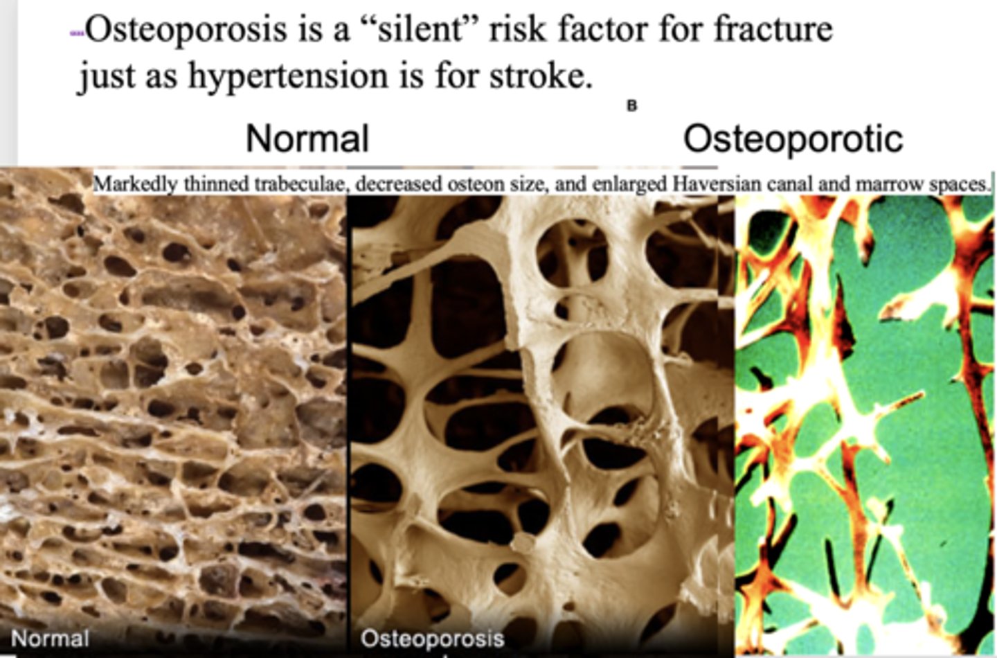 <p>fracture</p>
