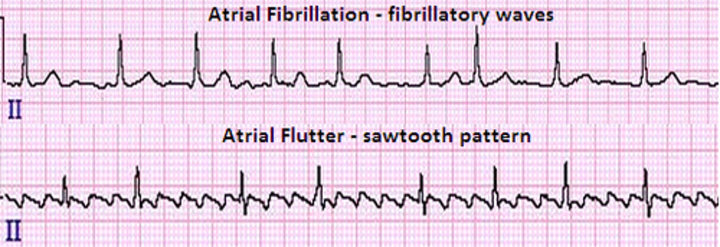 <p>SVT</p><p>rapid, regular heartbeats originating at or above the AV node</p><p>- atrial fibrillation (afib): atria quiver instead of normal beat</p><p>> no/ very coarse fibrillatory waves</p><p>- atrial flutter: atria depolarizes several times between each ventricular depolarization</p><p>> sawtooth</p>