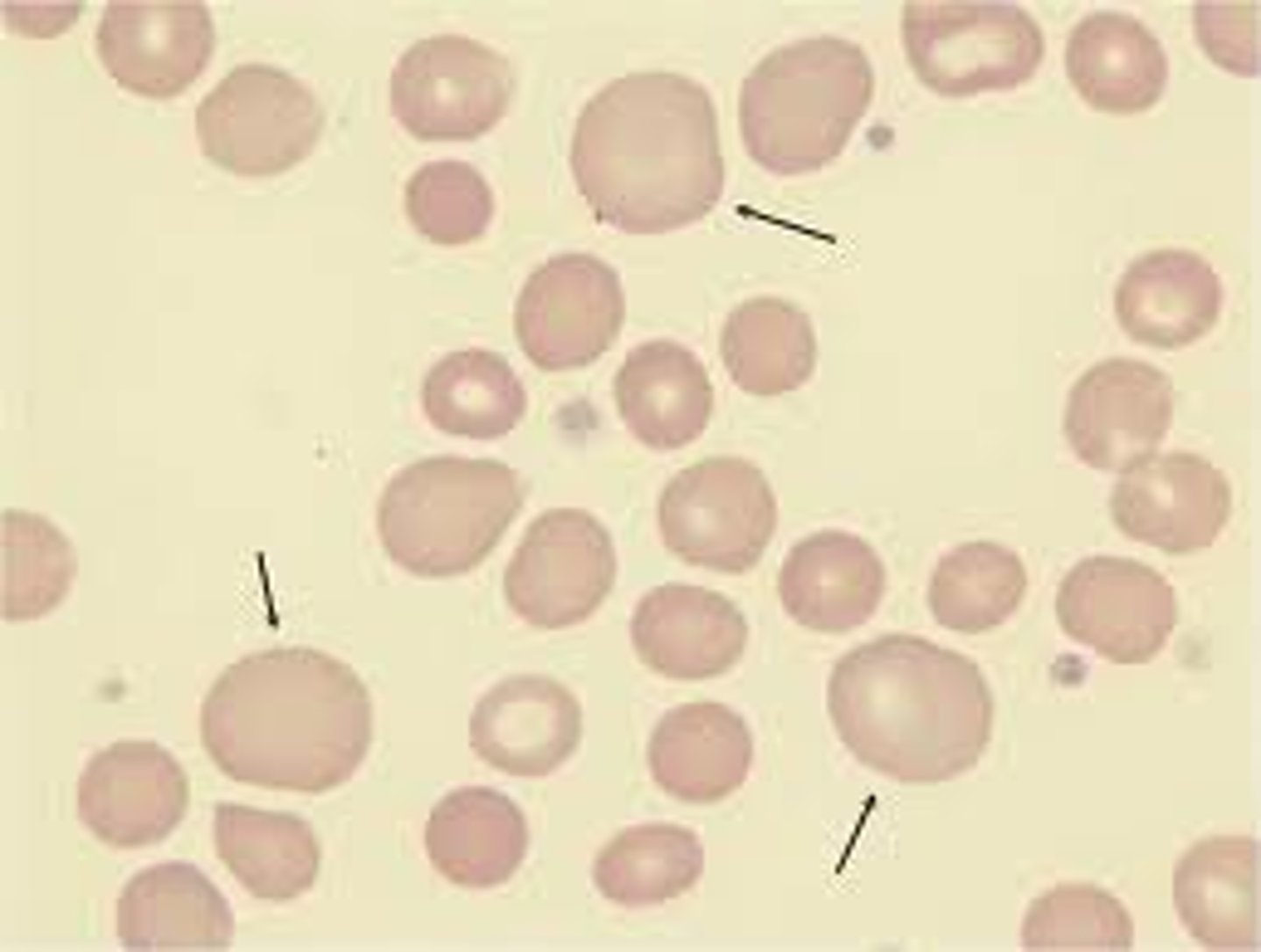 <p>large RBC</p><p>(&gt;100 fL)</p><p>Bigger than small lymphocyte&nbsp;</p>