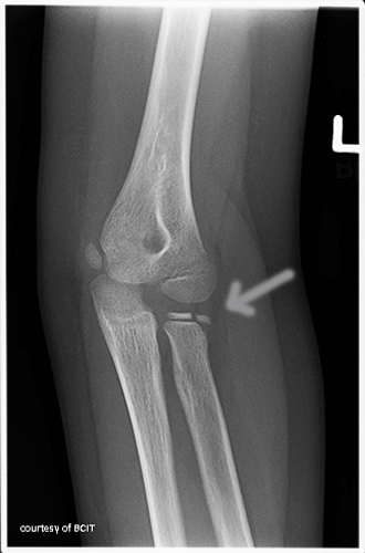 <p>Fracture through the epiphysis and across the growth plate, often involving a joint surface.</p>