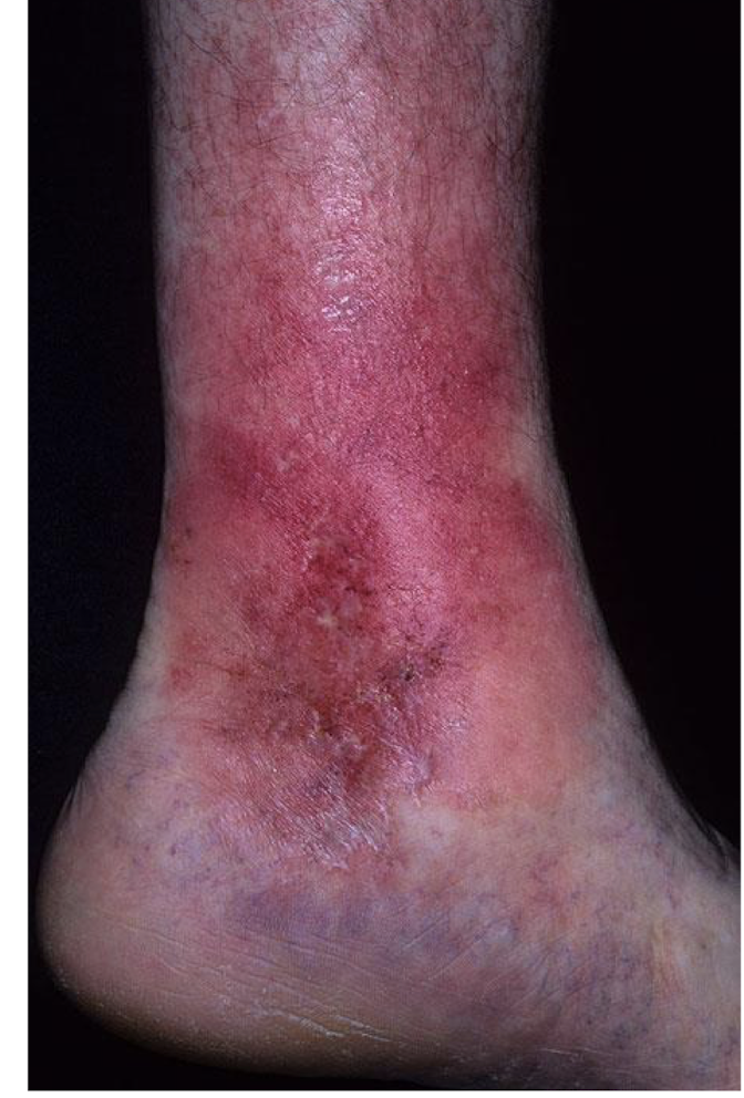 <ul><li><p>Worsening cellulitis</p></li><li><p>Cellulitis in diabetic or elderly pop</p></li><li><p>Unusual exudate from any wound </p></li><li><p>Increase in wound depth </p><ul><li><p>Bone, Tendon, Hardware, Other Deep Tissue</p></li></ul></li><li><p>Deep Compartment Infection </p></li></ul><p></p>