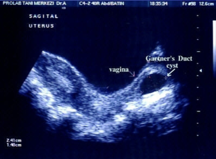 <ul><li><p>Benign cyst of the <span style="color: #0075ff"><strong>vagina</strong></span></p></li><li><p><span style="color: rgb(255, 0, 0)">Most common cystic lesion of the vagina</span></p></li><li><p>Usually develop along the <span style="color: rgb(0, 118, 255)">side walls of the vaginal canal</span></p></li></ul><p></p>